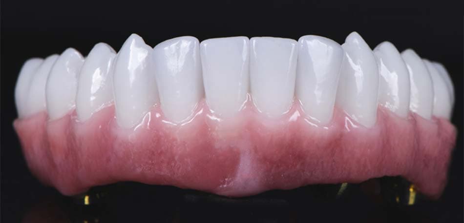 Full-arch implant teeth made for daily use