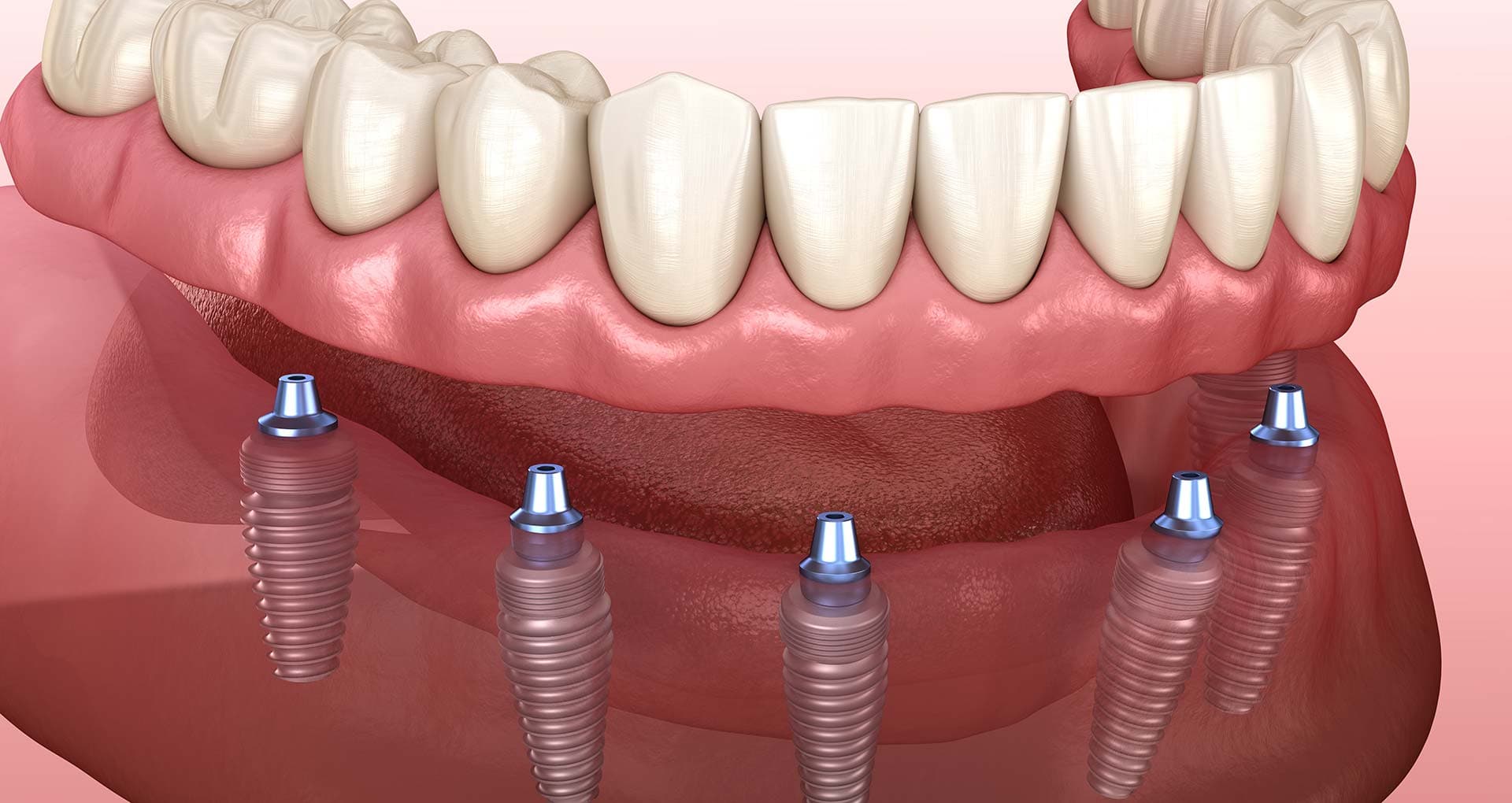 A fixed full-arch implant bridge