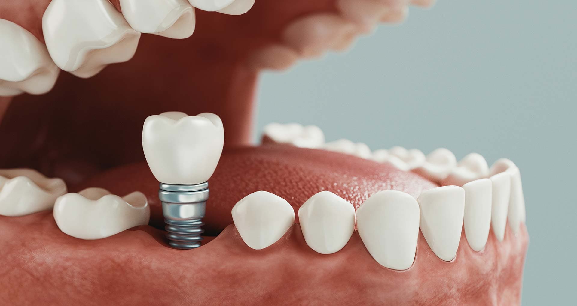 Illustration of a single dental implant replacing one tooth in the jaw